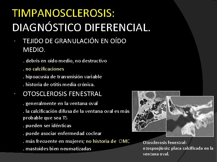 TIMPANOSCLEROSIS: DIAGNÓSTICO DIFERENCIAL. TEJIDO DE GRANULACIÓN EN OÍDO MEDIO. . debris en oído medio,