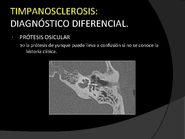 TIMPANOSCLEROSIS: DIAGNÓSTICO DIFERENCIAL. PRÓTESIS OSICULAR la prótesis de yunque puede lleva a confusión si