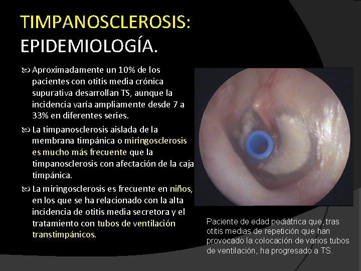 TIMPANOSCLEROSIS: EPIDEMIOLOGÍA. Aproximadamente un 10% de los pacientes con otitis media crónica supurativa desarrollan