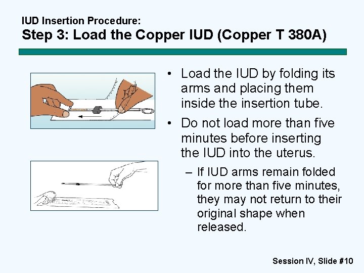 IUD Insertion Procedure: Step 3: Load the Copper IUD (Copper T 380 A) • IUD Insertion Procedure: Step 3: Load the Copper IUD (Copper T 380 A) •