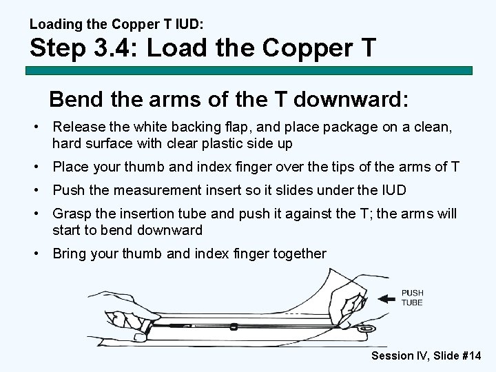 Loading the Copper T IUD: Step 3. 4: Load the Copper T Bend the Loading the Copper T IUD: Step 3. 4: Load the Copper T Bend the