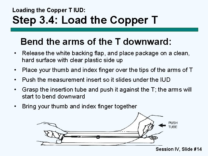 Loading the Copper T IUD: Step 3. 4: Load the Copper T Bend the