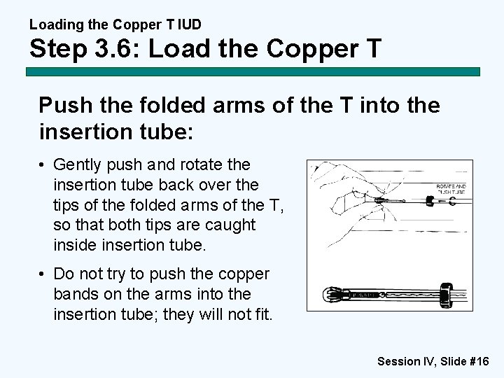 Loading the Copper T IUD Step 3. 6: Load the Copper T Push the