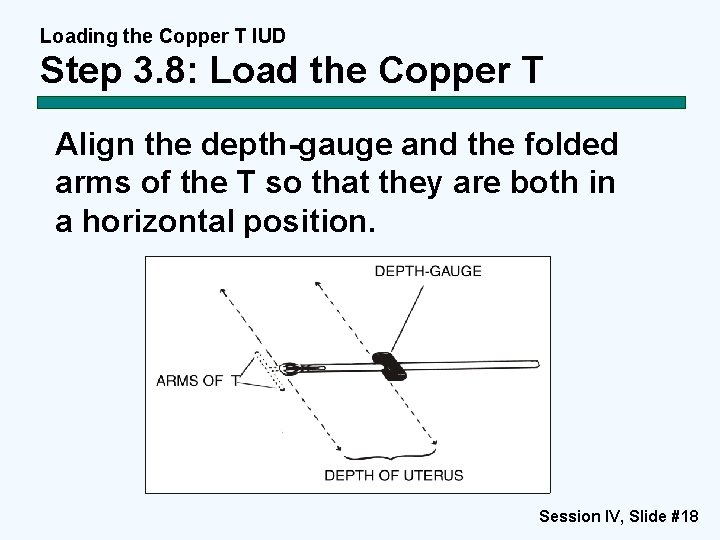 Loading the Copper T IUD Step 3. 8: Load the Copper T Align the