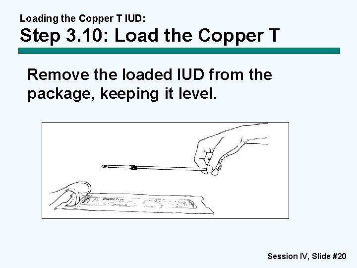 Loading the Copper T IUD: Step 3. 10: Load the Copper T Remove the