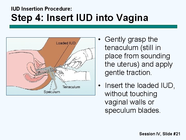 IUD Insertion Procedure: Step 4: Insert IUD into Vagina • Gently grasp the tenaculum IUD Insertion Procedure: Step 4: Insert IUD into Vagina • Gently grasp the tenaculum