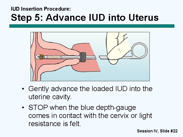 IUD Insertion Procedure: Step 5: Advance IUD into Uterus • Gently advance the loaded IUD Insertion Procedure: Step 5: Advance IUD into Uterus • Gently advance the loaded