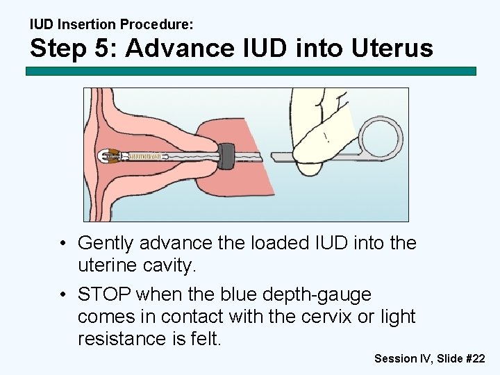 IUD Insertion Procedure: Step 5: Advance IUD into Uterus • Gently advance the loaded