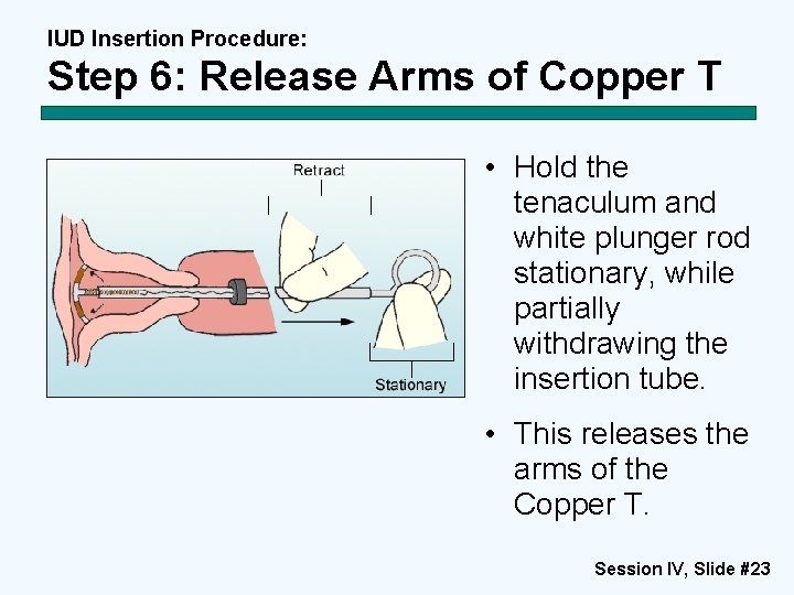 IUD Insertion Procedure: Step 6: Release Arms of Copper T • Hold the tenaculum