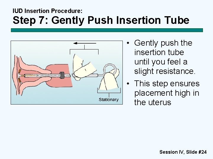 IUD Insertion Procedure: Step 7: Gently Push Insertion Tube • Gently push the insertion IUD Insertion Procedure: Step 7: Gently Push Insertion Tube • Gently push the insertion