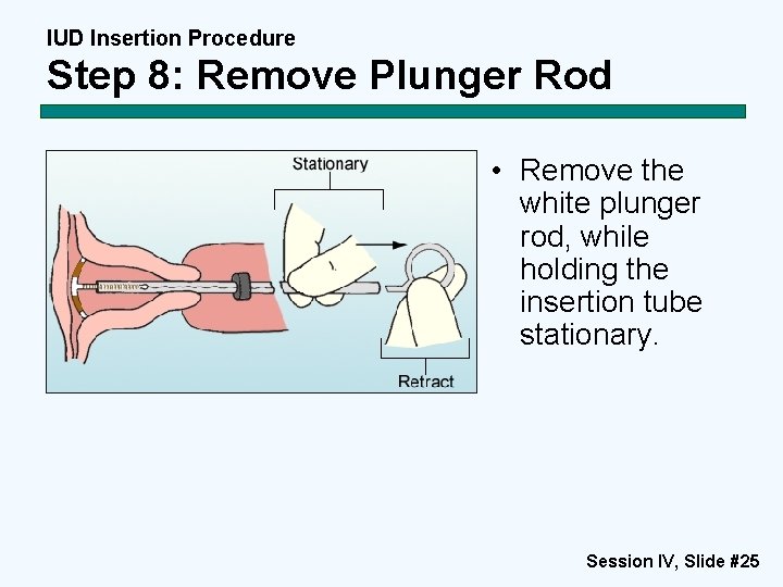 IUD Insertion Procedure Step 8: Remove Plunger Rod • Remove the white plunger rod, IUD Insertion Procedure Step 8: Remove Plunger Rod • Remove the white plunger rod,