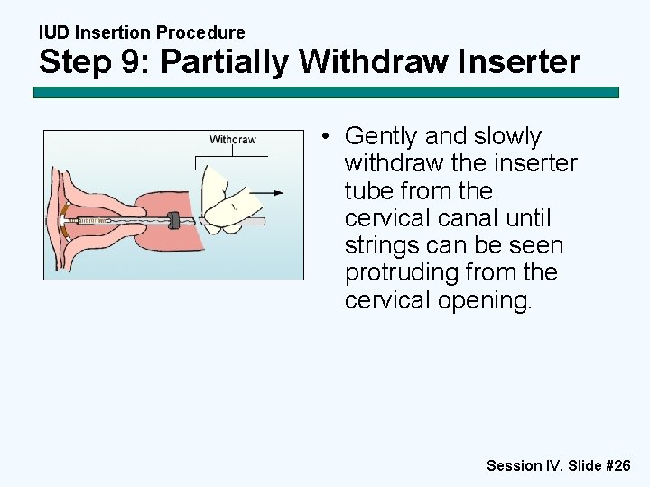 IUD Insertion Procedure Step 9: Partially Withdraw Inserter • Gently and slowly withdraw the IUD Insertion Procedure Step 9: Partially Withdraw Inserter • Gently and slowly withdraw the