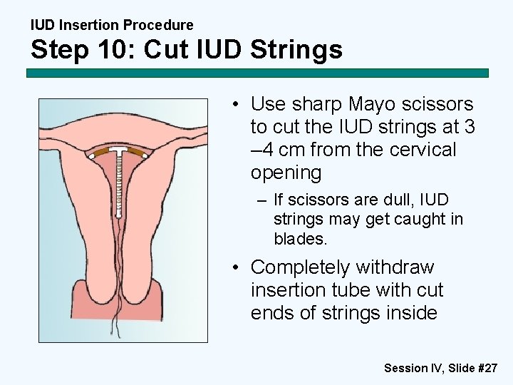 IUD Insertion Procedure Step 10: Cut IUD Strings • Use sharp Mayo scissors to