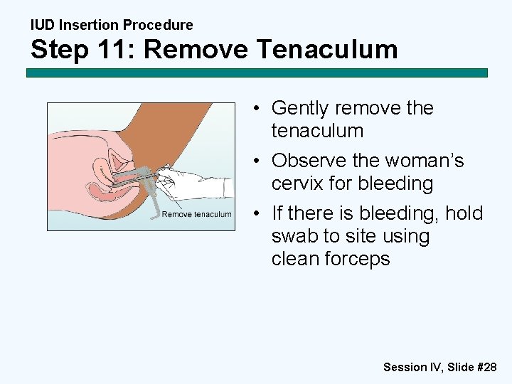 IUD Insertion Procedure Step 11: Remove Tenaculum • Gently remove the tenaculum • Observe