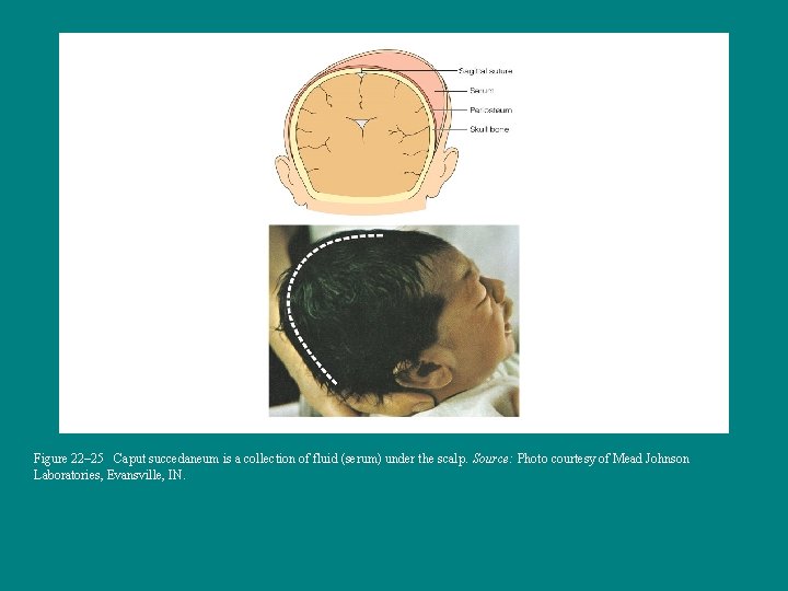 Figure 22– 25 Caput succedaneum is a collection of fluid (serum) under the scalp.