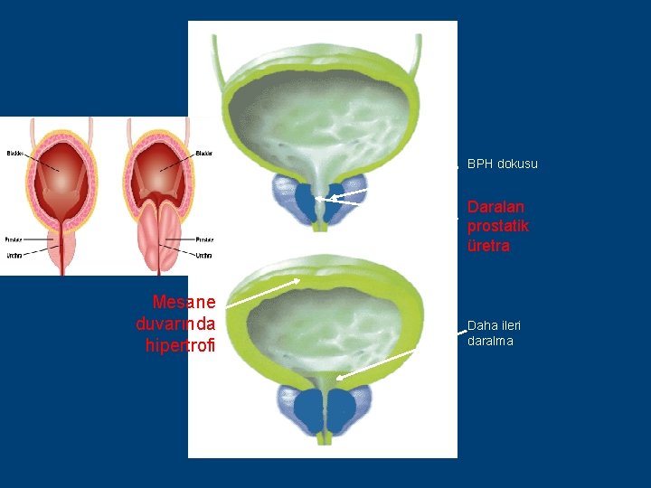 BPH dokusu Daralan prostatik üretra Mesane duvarında hipertrofi Daha ileri daralma 