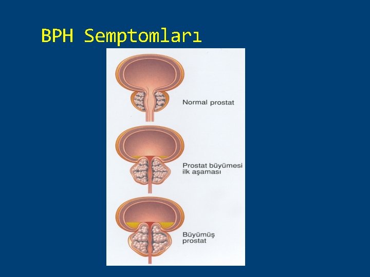 BPH Semptomları 