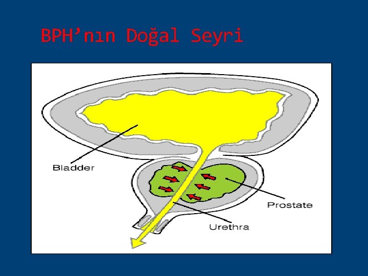 BPH’nın Doğal Seyri 