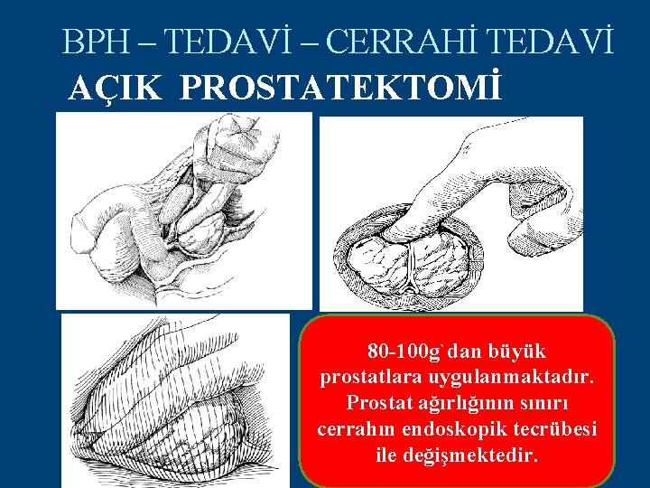 BPH – TEDAVİ – CERRAHİ TEDAVİ AÇIK PROSTATEKTOMİ 80 -100 g`dan büyük prostatlara uygulanmaktadır.