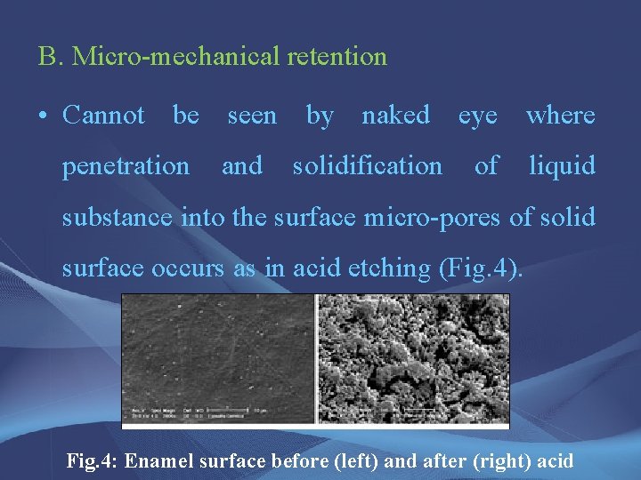 B. Micro-mechanical retention • Cannot be seen by naked eye where penetration and solidification