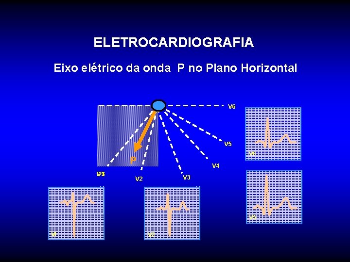 ELETROCARDIOGRAFIA Eixo elétrico da onda P no Plano Horizontal V 6 V 5 V