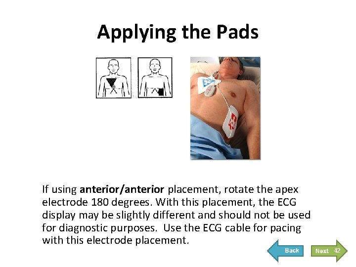 Applying the Pads If using anterior/anterior placement, rotate the apex electrode 180 degrees. With