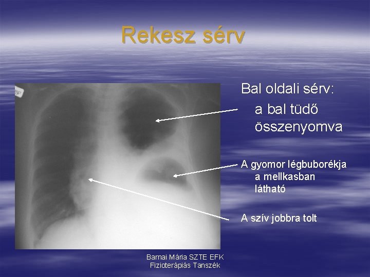 Rekesz sérv Bal oldali sérv: a bal tüdő összenyomva A gyomor légbuborékja a mellkasban