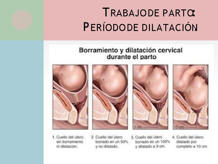 T RABAJO DE PARTO: P ERÍODO DE DILATACIÓN. 