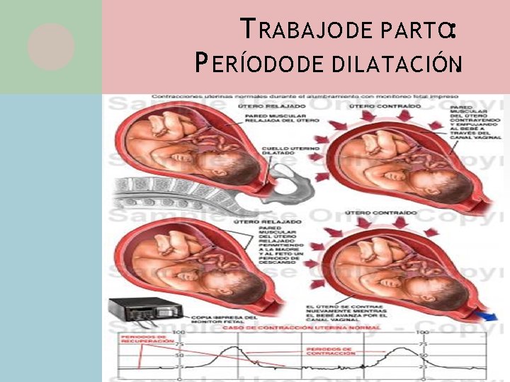 T RABAJO DE PARTO: P ERÍODO DE DILATACIÓN. • Mecanismos de acción: Contracciones uterinas: