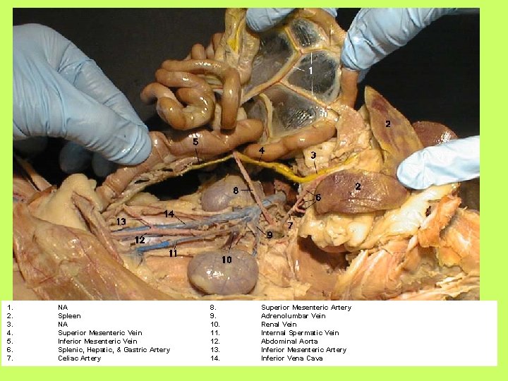 1. 2. 3. 4. 5. 6. 7. NA Spleen NA Superior Mesenteric Vein Inferior