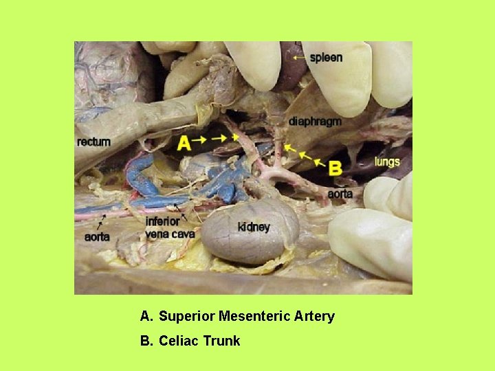 A. Superior Mesenteric Artery B. Celiac Trunk 