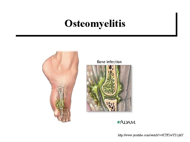 Osteomyelitis http: //www. youtube. com/watch? v=KTf. Ow. YS 1 yk. Y 