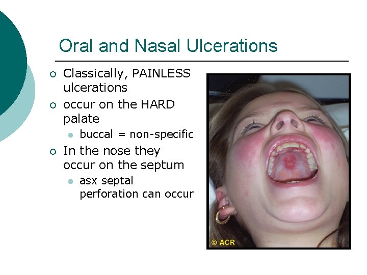 Oral and Nasal Ulcerations ¡ ¡ Classically, PAINLESS ulcerations occur on the HARD palate