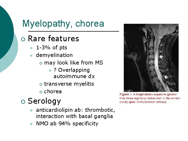 Myelopathy, chorea ¡ Rare features l l ¡ 1 -3% of pts demyelination ¡