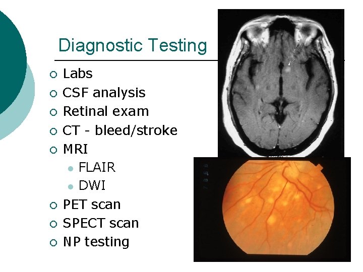 Diagnostic Testing ¡ ¡ ¡ ¡ Labs CSF analysis Retinal exam CT - bleed/stroke