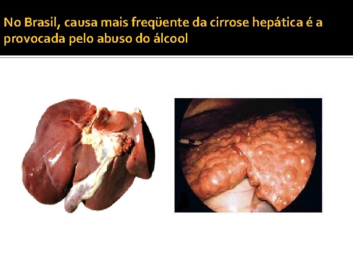 No Brasil, causa mais freqüente da cirrose hepática é a provocada pelo abuso do