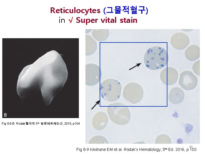  Reticulocytes (그물적혈구) in √ Super vital stain Fig 8 -8 B Rodak혈액학 5