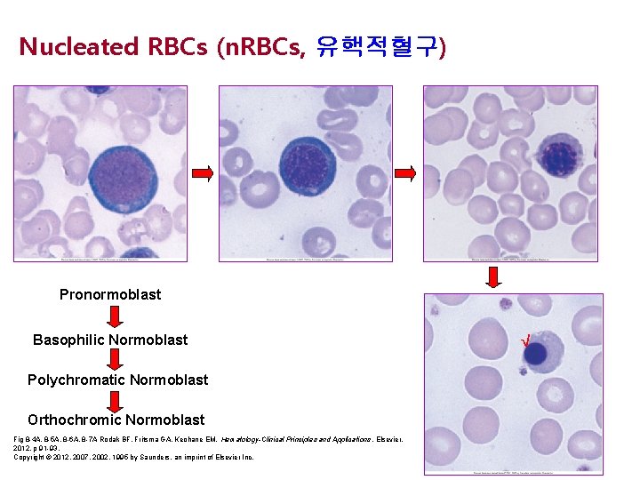 Nucleated RBCs (n. RBCs, 유핵적혈구) Pronormoblast Basophilic Normoblast √ Polychromatic Normoblast Orthochromic Normoblast Fig