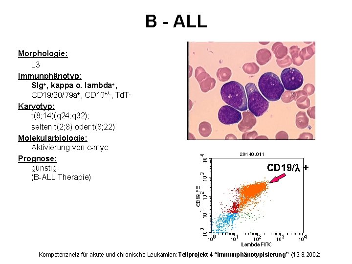 B - ALL Morphologie: L 3 Immunphänotyp: SIg+, kappa o. lambda+, CD 19/20/79 a+,