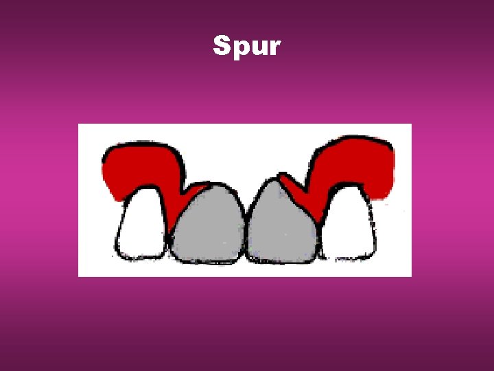 Spur 