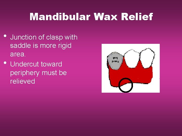 Mandibular Wax Relief • Junction of clasp with • saddle is more rigid area.