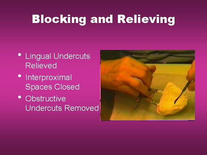 Blocking and Relieving • Lingual Undercuts • • Relieved Interproximal Spaces Closed Obstructive Undercuts