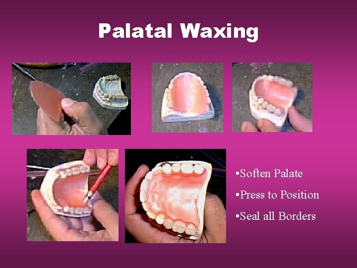 Palatal Waxing • Soften Palate • Press to Position • Seal all Borders 