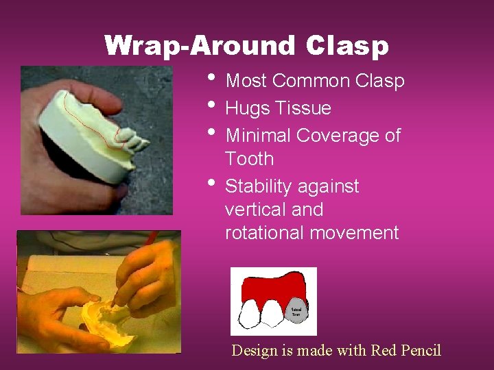 Wrap-Around Clasp • Most Common Clasp • Hugs Tissue • Minimal Coverage of •