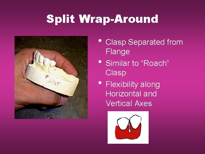 Split Wrap-Around • Clasp Separated from • • Flange Similar to “Roach” Clasp Flexibility