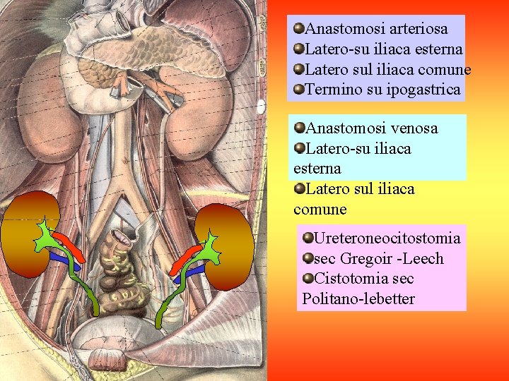 Anastomosi arteriosa Latero-su iliaca esterna Latero sul iliaca comune Termino su ipogastrica Anastomosi venosa