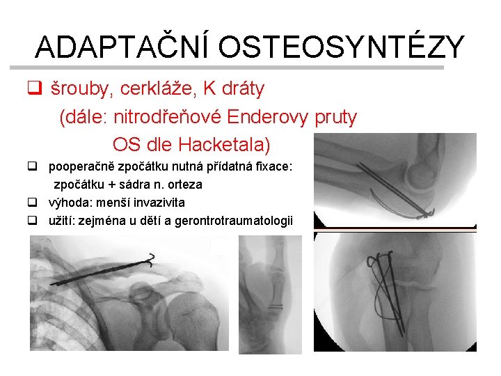 ADAPTAČNÍ OSTEOSYNTÉZY q šrouby, cerkláže, K dráty (dále: nitrodřeňové Enderovy pruty OS dle Hacketala)