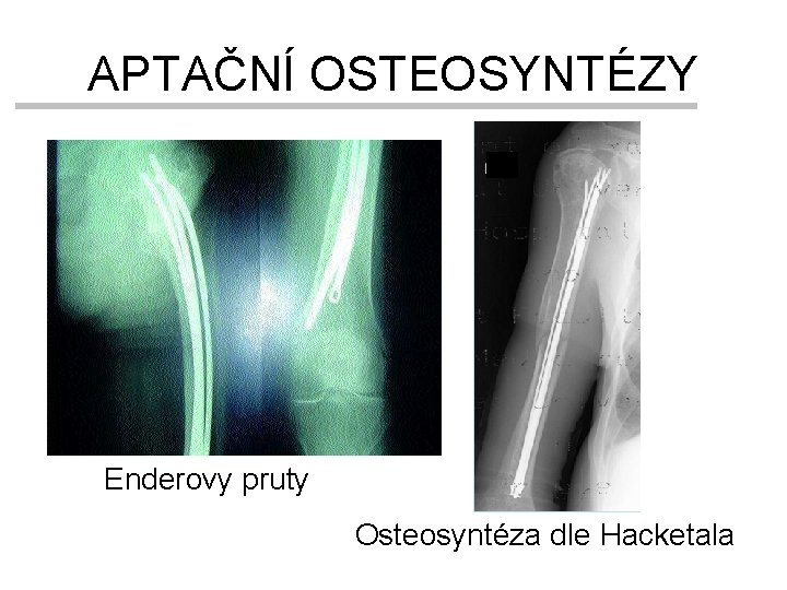 APTAČNÍ OSTEOSYNTÉZY Enderovy pruty Osteosyntéza dle Hacketala 