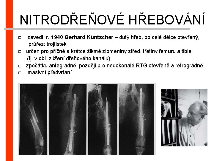 NITRODŘEŇOVÉ HŘEBOVÁNÍ zavedl: r. 1940 Gerhard Küntscher – dutý hřeb, po celé délce otevřený,