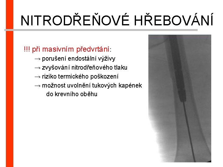 NITRODŘEŇOVÉ HŘEBOVÁNÍ !!! při masivním předvrtání: → porušení endostální výživy → zvyšování nitrodřeňového tlaku